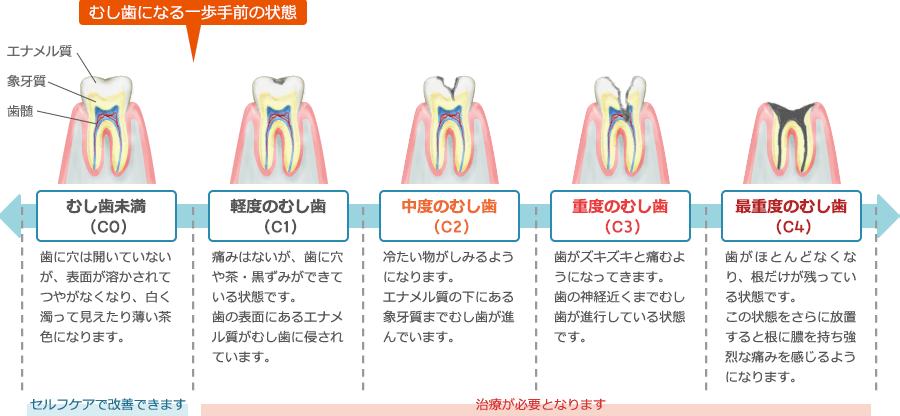 むし歯の進行と治療について